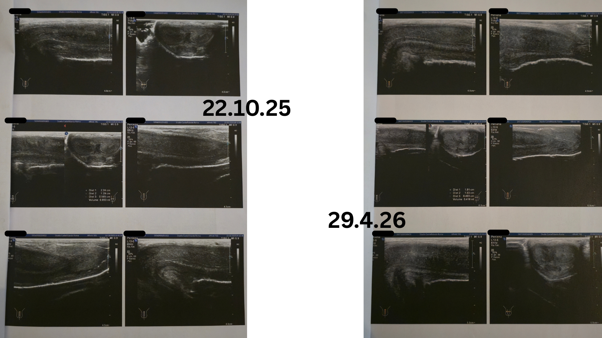 Side-by-side B-mode ultrasound scans of the tunica albuginea. Left column dated 22.10.25 shows the initial septal plaque. Right column dated 29.4.26 shows the same region after six months on protocol, with markedly reduced plaque volume.